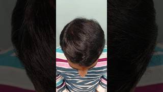 4 Months after Hair Transplant for 3000 grafts [upl. by Maible]