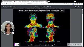 Dental Thermography 5 Powerful Case Studies [upl. by Yclehc501]