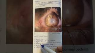 hsv keratitis  stromal keratitis  necrotic and disciform keratitis  cornea part 9 [upl. by Ennoid]