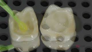 CEMENTACIÓN ZIRCONIA RELYX ULTIMATE [upl. by Urbas278]