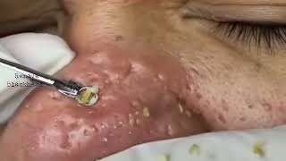 Blackhead Removal on his nose  Remove Blackhead removeblackhead [upl. by Lopez366]