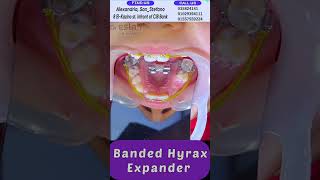 رهيب توسيع الفك العلوي  Hyrax expander [upl. by Salguod]