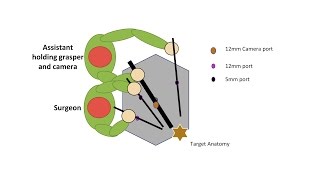 Learning Laparoscopic Sigmoid Colectomy High Anterior Resection [upl. by Kingdon]