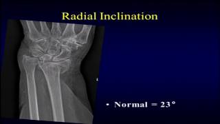 Distal radius fractures what to look for on radiographs [upl. by Ninerb453]