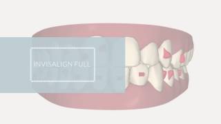 Invisalign Full ClinCheck  Invisalign casos difíciles [upl. by Sarilda]