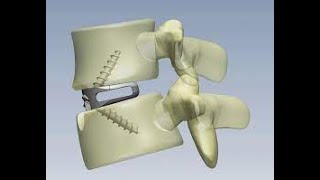 Anterior Lumbar Interbody Fusion [upl. by Yance]