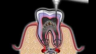 Wurzelbehandlung beim Zahnarzt [upl. by Grega]