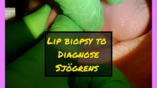 Lip Biopsy to Help Diagnose Sjögrens Disease [upl. by Warfourd]