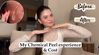 Chemical Peel Final Results😍  Cost amp Experience  Shilpa Chaudhary [upl. by Ragse742]