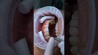 Porcelain veneers for gap teeth veneers dental dentist [upl. by Garcia67]