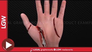 Left Hand Injury Animated Surgery Recreation [upl. by Alak]