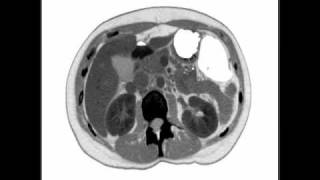 Duodenal HematomaPerforation [upl. by Mixie]