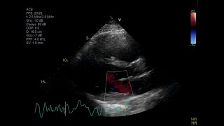 Fatal Giant Cell Myocarditis [upl. by Nafets189]