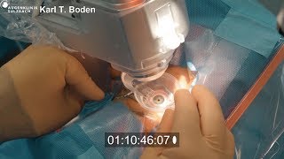 Live Chirurgie Femtosekundenlaserassistierte Keratoplastik mit neuartigem Liquid Interface [upl. by Giustina651]