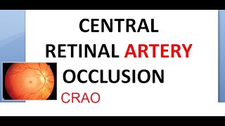 Ophthalmology CRAO Central Retinal Artery Occlusion Cherry Red Spot Cattle Tracking Marcus Gunn [upl. by Priscilla]