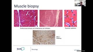 Dermatomyositis clinical case and treatment [upl. by Schwenk]