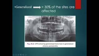 Chronic Periodontitis [upl. by Amersham965]