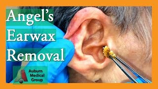 Angels Earwax Removal  Auburn Medical Group [upl. by Illek]