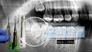 Lower Impacted Wisdom Tooth Extraction  Black  White Version [upl. by Ahsekad]