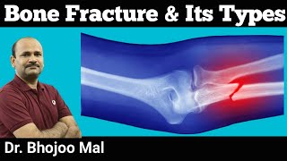 Bone Fracture and Its Types  Class 12 Biology  by Dr Bhojoo Mal [upl. by Aeikan306]