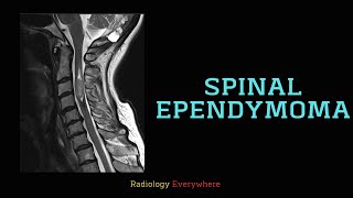 Spinal Ependymoma Radiology Tutorial Radiology Everywhere [upl. by Fiester598]