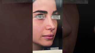 Reconstructive nose surgery with Dr Bashartizadeh جراحی ترمیمی بینی با دکتر بشارتی زاده [upl. by Appel819]