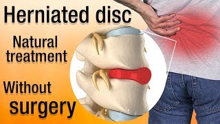 How to heal a herniated disc naturally Treatment and recovery [upl. by Kelsey]