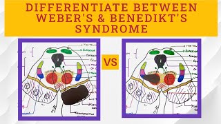 Midbrain Syndromes  Benedikts VS Webers syndrome [upl. by Sirtaeb146]