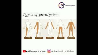 paralysis hemiplegia quadriplegia monoplegia diplegia neurophysiotherapy crystalphysio [upl. by Duke]