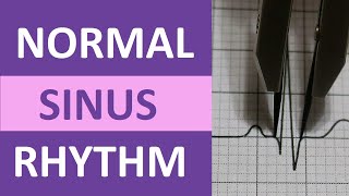 Normal Sinus Rhythm Nursing Made Easy on ECGEKG Heart Interpretation [upl. by Eeryk455]