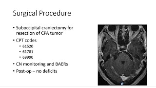 AANS Coding Shorts Cerebellopontine Angle Tumor Resection [upl. by Isoj]