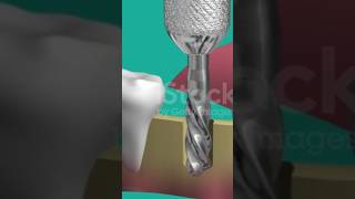 Teeth Removal Process teeth teethdoctor medical trendingshorts trending shorts short funny [upl. by Chiquia]