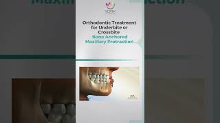 Orthodontic Treatment for Underbite or Crossbite Bone Anchored Maxillary Protraction [upl. by Braden]