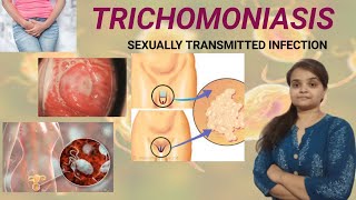 TRICHOMONIASIS cause treatmentprevention [upl. by Amandi]