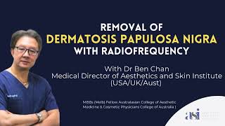 Removal of Dermatosis Papulosa Nigra with Radiofrequency [upl. by Evans592]