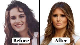 Melania Trump NEW LOOK  Plastic Surgery Analysis [upl. by Vassily]