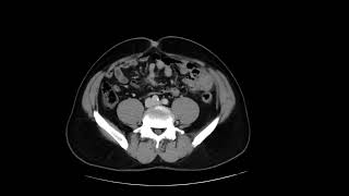 Small Bowel Carcinoid [upl. by Ayila]