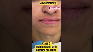 Class 3 malocclusion with anterior cross bite and prognathic jaw [upl. by Oringas]