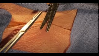 Basic Skills Sutures and Knot Tying Subcuticular Running Suture [upl. by Ysac]