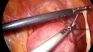 STEP 1  BOWEL AND OMENTAL ADHESIOLYSIS [upl. by Jaeger]