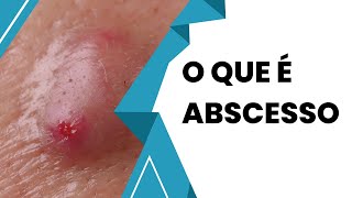 Descubra Tudo Sobre Abscesso e Como Tratar [upl. by Ainsworth]