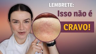 3 dicas de como tirar os cravos  Dica de Esteticista [upl. by Eylsel]