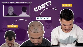 Advanced technique Hair transplant surgery cost of hair transplant [upl. by Salta]