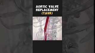 Arotic valve Replacement doctor mbbs intramuscularinjection medicalprocedure subscribe short [upl. by Latsirc]