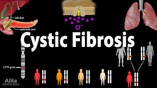 Cystic Fibrosis Pathophysiology Genetics Symptoms Diagnosis and Treatments Animation [upl. by Naliorf]