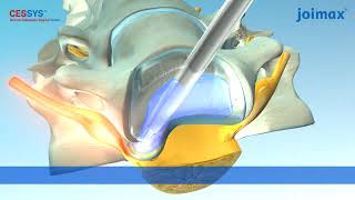 CESSYS®  Cervical Endoscopic Surgery System [upl. by Ardnuaek450]