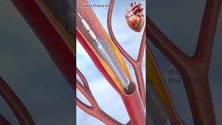 Coronary AngioplastyHeart stenting for atherosclerosis [upl. by Nogas]