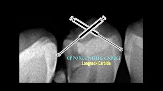 Opportunistic Caries  Minimally Invasive Approach [upl. by Jemma]