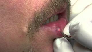 Venous Lake of Lip and Lip Freckle Removal with Iridex Laser [upl. by Bindman]