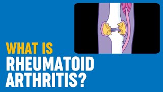 What is rheumatoid arthritis [upl. by Agnese]